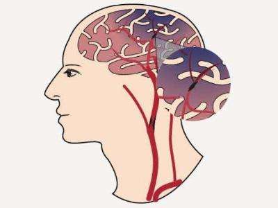 什么是tms(经颅磁刺激) 什么是tms(经颅磁刺激)