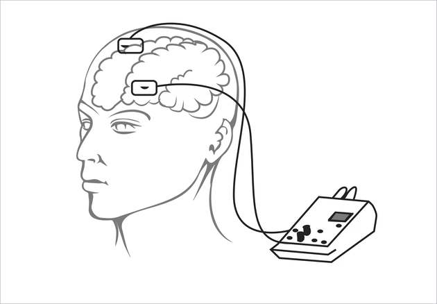 经颅磁刺激（TMS）在失眠中的应用