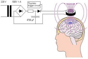 应用广泛，技术成熟的神经调控技术——重复经颅磁刺激
