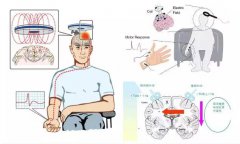 经颅磁刺激仪有用吗