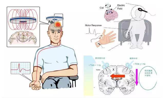 经颅磁刺激仪有用吗