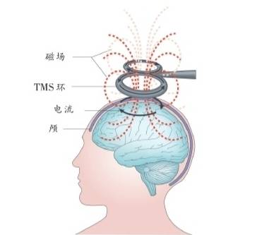 经颅磁刺激安全吗？